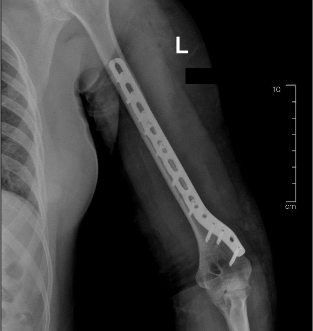 X-ray front view of an arm (humerus) fracture fixed with a long plate