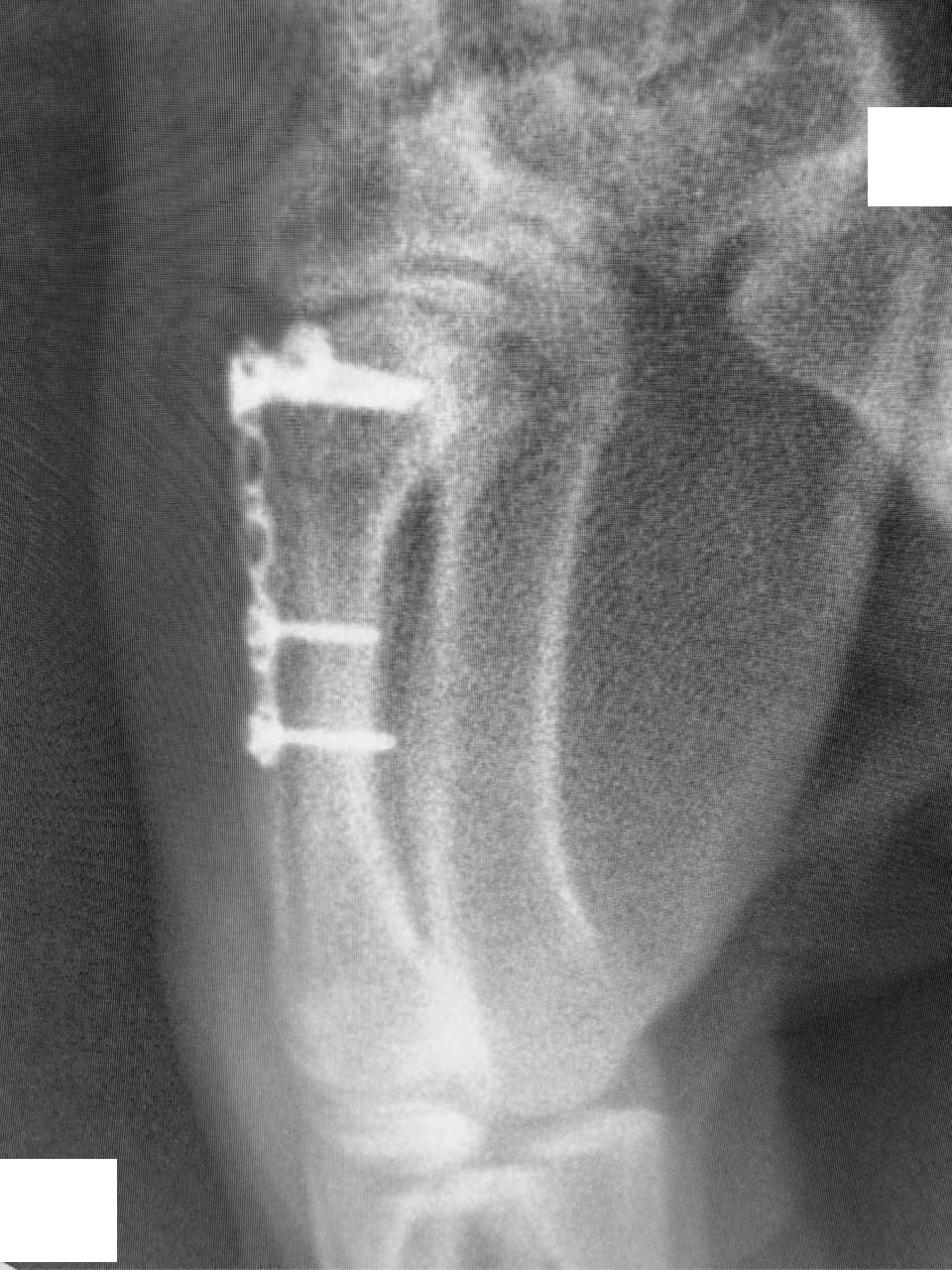 C-arm close-up of arm plate fixation during surgery