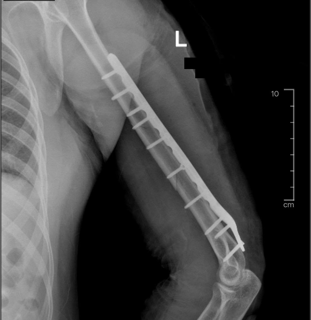 X-ray side view of an arm (humerus) fracture fixed with a long plate