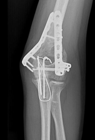 X-ray of a complex elbow fracture fixed with plates and screws