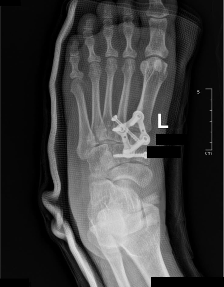X-ray AP view of midfoot fusion fixed with a plate