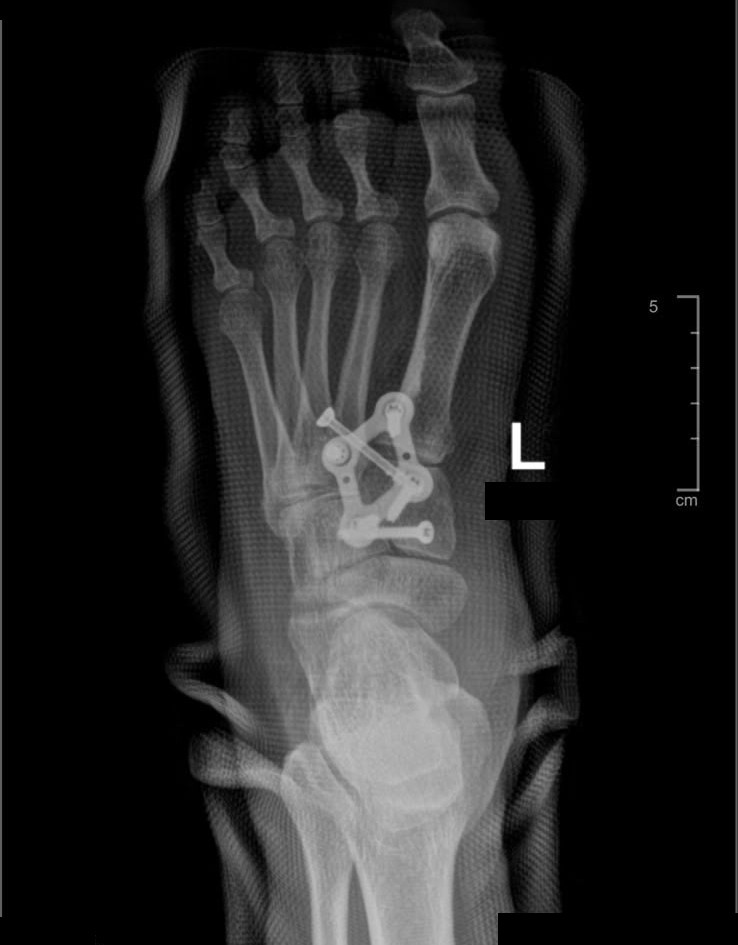 X-ray oblique view of midfoot fusion fixed with a plate
