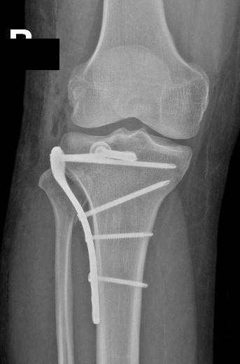 X-ray of a knee (tibial plateau) fracture fixed with a buttress plate