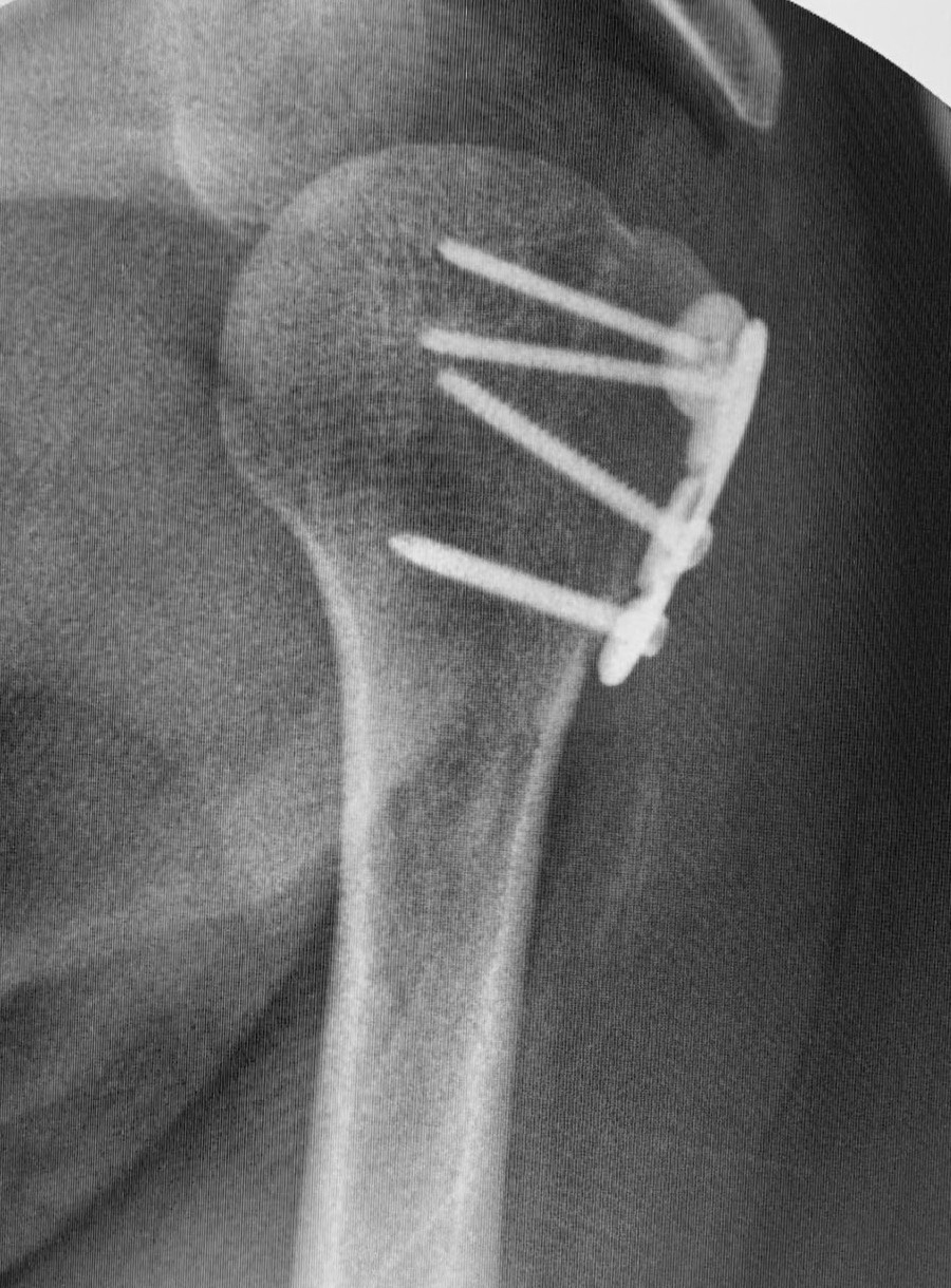 X-ray of a shoulder (proximal humerus) fracture fixed with a locking plate