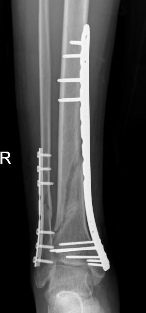 X-ray of tibia and fibula fractures fixed with plates and screws