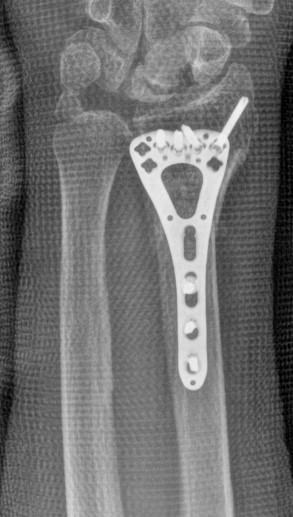 X-ray of a wrist (distal radius) fracture fixed with a volar locking plate