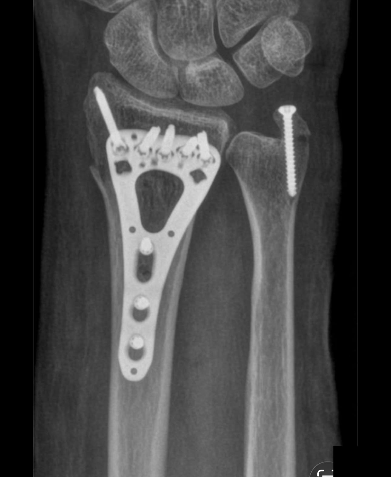 X-ray of wrist and ulna fractures fixed with a plate and screw